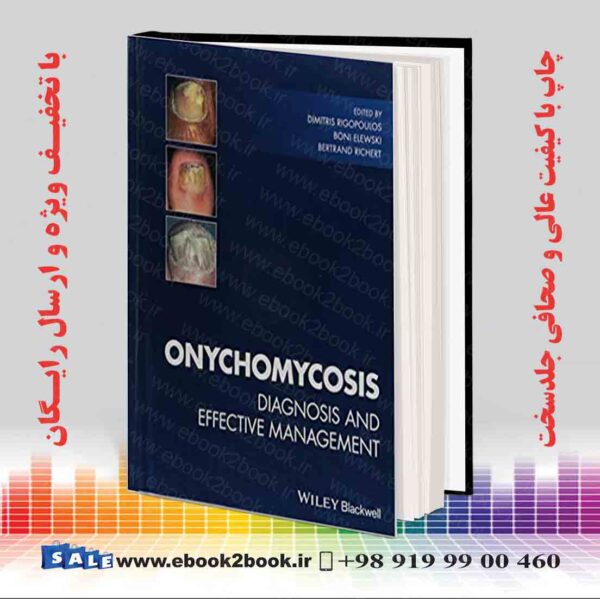 کتاب Onychomycosis: Diagnosis And Effective Management